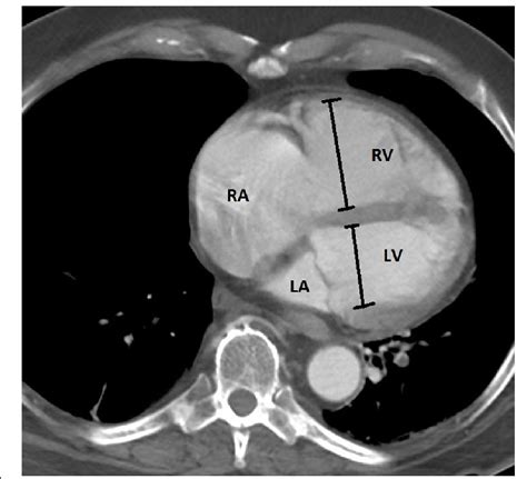 rv to lv ratio|rv Lv ratio pulmonary embolism.